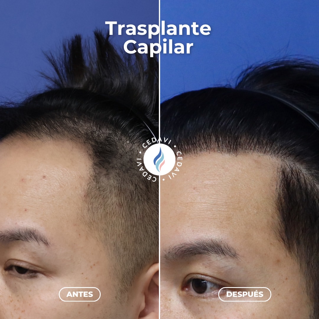 Before and after hairline hair transplant at CEDAVI — a natural, restored front hairline